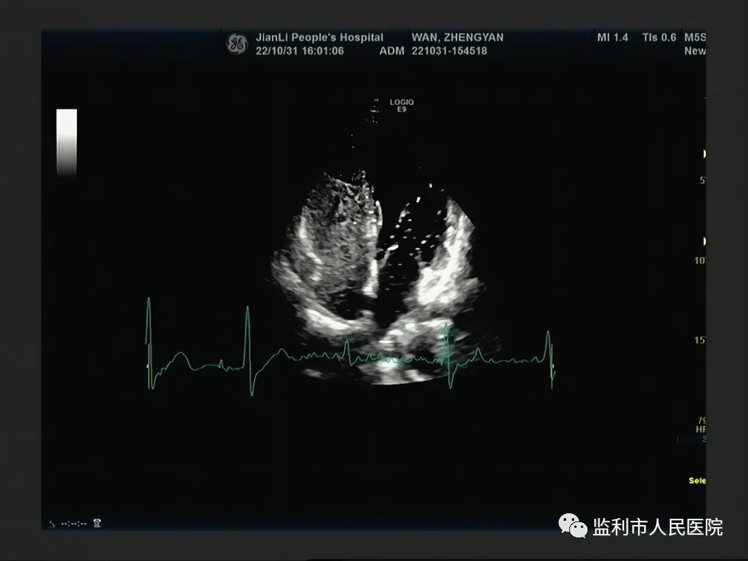 超声影像科成功开展心脏右心声学造影